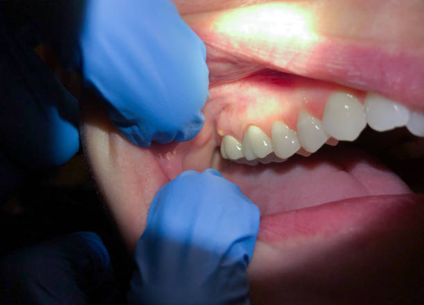 Best Emergency Wisdom Teeth Removal in Rolesville, NC