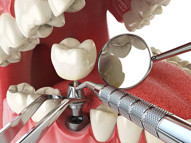 Best Emergency Root Canal Treatment in Rolesville, NC